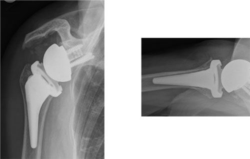 AP and axillary x-rays after reverse total shoulder replacement for cuff tear arthropathy