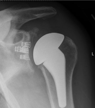 x-ray showing anatomic total shoulder replacement with a stemmed humeral component and caged glenoid