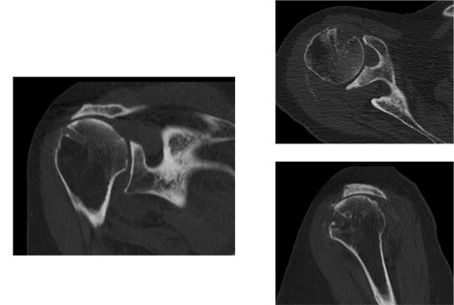 CT scan showing glenoid wear and bone loss in cuff tear arthropathy before reverse shoulder replacement