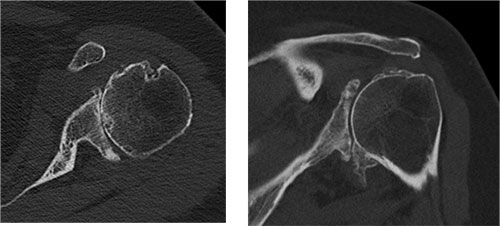 axial CT slices showing posterior glenoid wear and retroversion in glenohumeral osteoarthritis