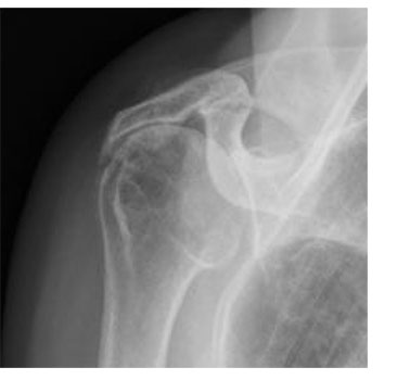 x-ray showing cuff tear arthropathy with superior migration of the humeral head and loss of the acromiohumeral interval