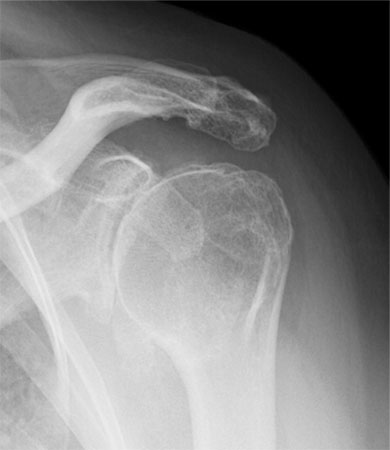 x-ray showing glenohumeral osteoarthritis with joint space loss and an inferior humeral osteophyte