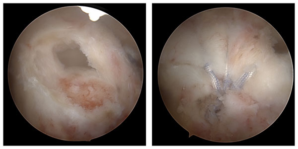 side by side x-ray comparison of anatomic and reverse total shoulder replacement showing the reversed ball and socket positions