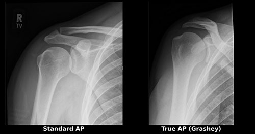 standard AP shoulder x-ray compared with a true AP Grashey view showing the glenohumeral joint space clearly Credit line: None required. Dr. Ode’s case material.