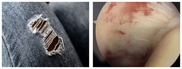 side by side comparison of worn jeans and an arthroscopic view of a low grade articular sided partial thickness rotator cuff tear