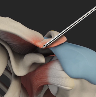 AC Joint Stabilization