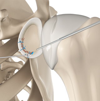 Arthroscopic Bankart Repair