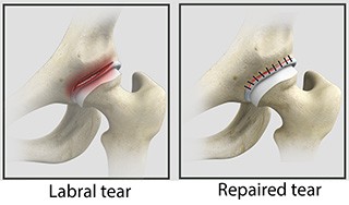 Hip Labral Repair
