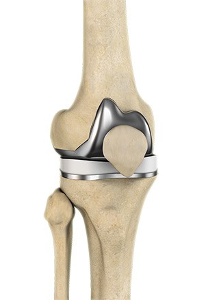 Knee Replacement