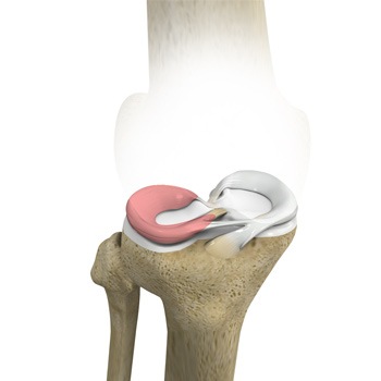 Lateral Meniscus Syndrome