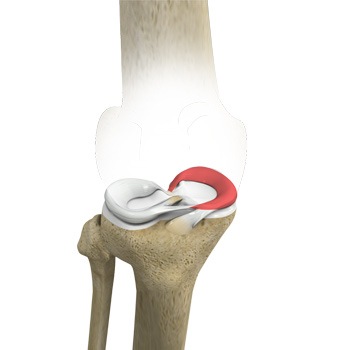 Medial Meniscus Syndrome