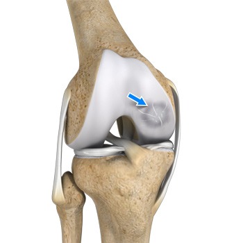 Osteochondritis Dissecans