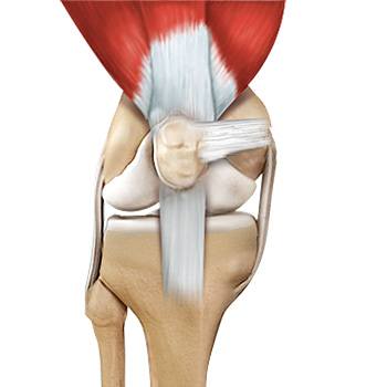 Quadriceps Tendon Rupture