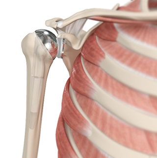 Shoulder Joint Replacement