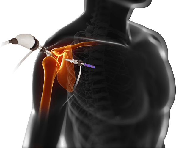 Minimally Invasive Techniques