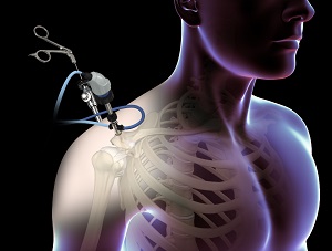 Shoulder Arthroscopy
