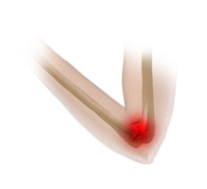 UCL Reconstruction (Tommy John Surgery)