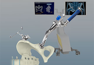 Computer-Navigated Total Hip Replacement
