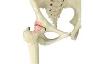 Femoroacetabular Impingement