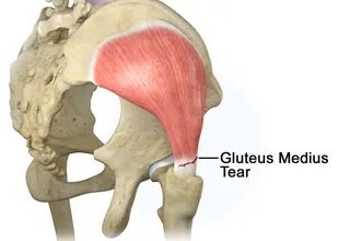 Gluteus Medius Tear