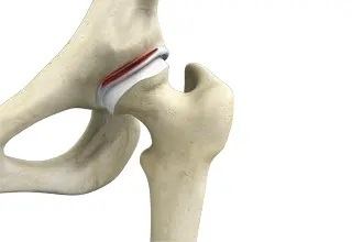 Hip Labral Tear