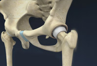 Hip Resurfacing