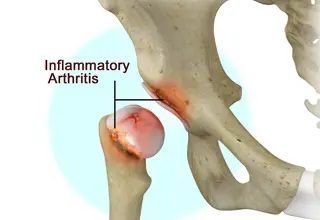Inflammatory Arthritis of the Hip