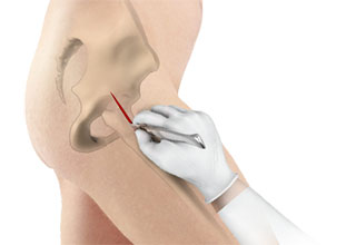 Minimally Invasive Direct Anterior Hip Replacement