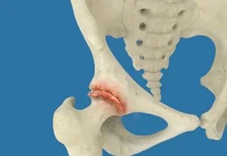 Osteoarthritis of the Hip