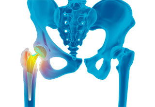 Revision Hip Replacement