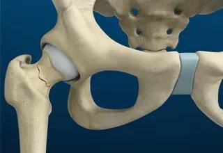 Stress Fractures of the Hip