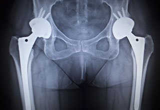 X-ray Guided Hip Replacement