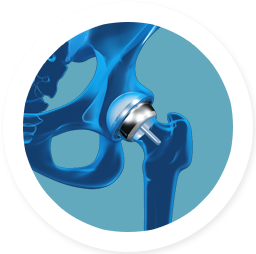 BIRMINGHAM HIP RESURFACING