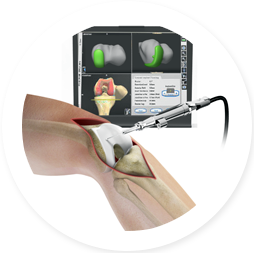 COMPUTER ASSISTED KNEE REPLACEMENT