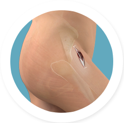 MINIMAL INVASIVE DIRECT ANTERIOR HIP REPLACEMENT