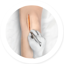 MINIMAL INVASIVE KNEE REPLACEMENT