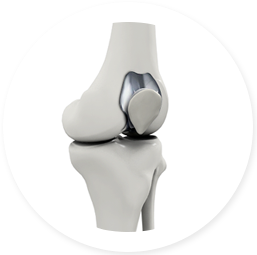 PATELLOFEMORAL KNEE JOINT REPLACEMENT
