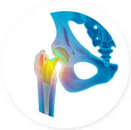 REVISION HIP AND KNEE REPLACEMENT