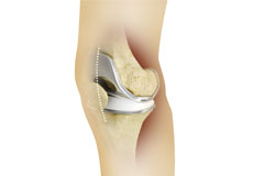 Minimally Invasive Knee Surgery