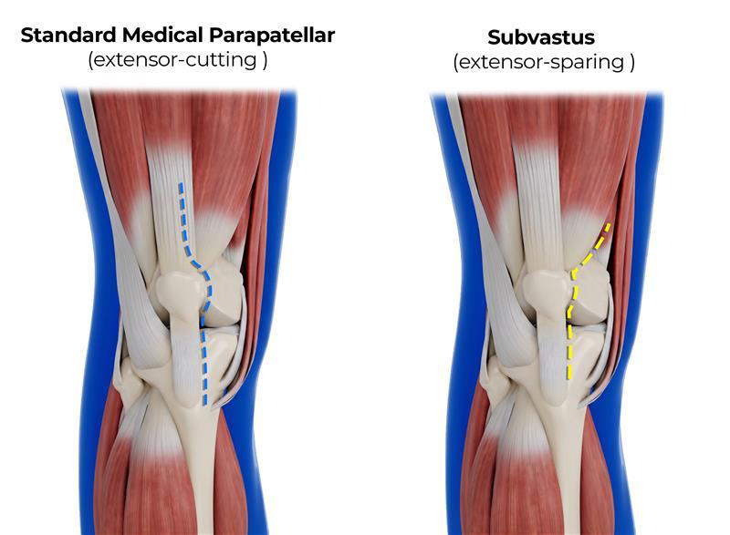 Muscle and Tendon-Sparing Knee Replacement
