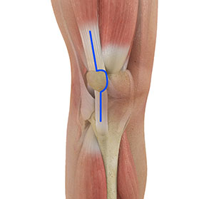 Muscle and Tendon-Sparing Knee Replacement