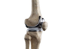 Narcotic-Free Knee Replacement