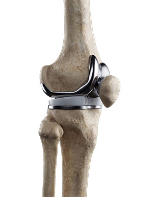 Narcotic-Free Knee Replacement