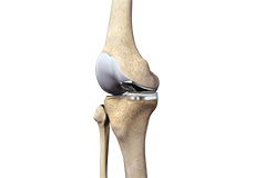 partial-medial-knee-replacement