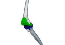 Robotic Knee Replacement