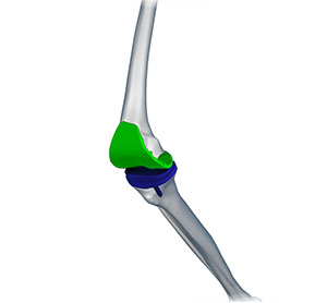 Robotic Knee Replacement