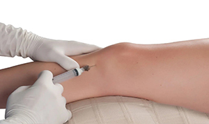 Intraarticular Knee Injection