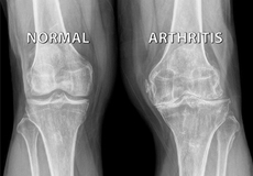 Knee Arthritis