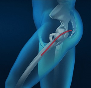 Posterior Hip Replacement Surgery
