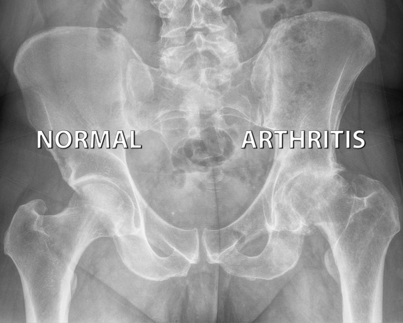 Diagnosis of Hip Arthritis
